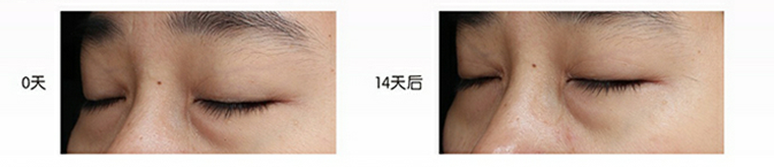 乙酰基四肽-5临床测试